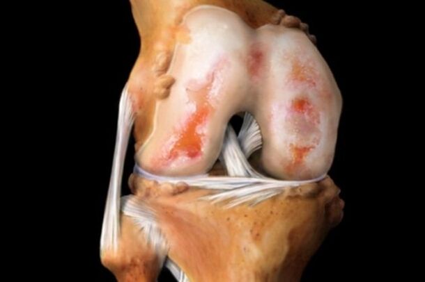 Destrución da articulación do xeonllo debido á artrose - unha patoloxía común do sistema músculo-esquelético