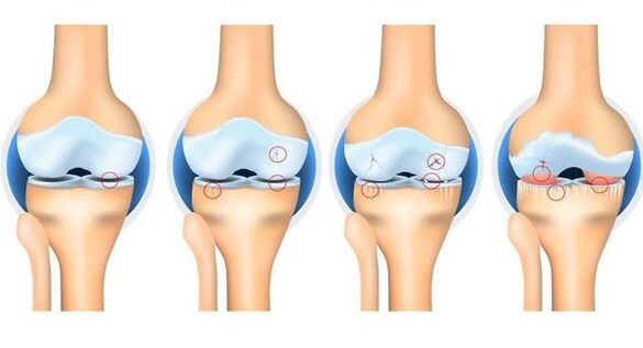 Etapas da osteorrose