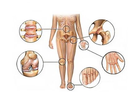 Tipos de artrose