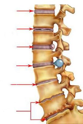Como se desenvolve a osteocondrose