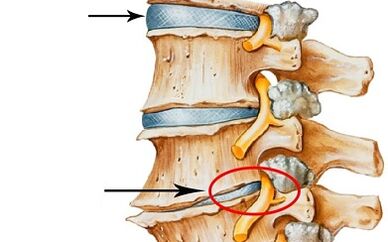 etapas de desenvolvemento da osteocondrose cervical
