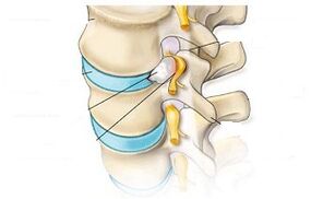 Principais síntomas da osteocondrose cervical