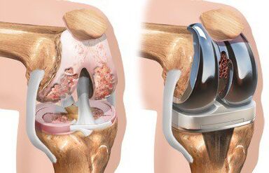 Endoprótesis da articulación do xeonllo con gonartrose
